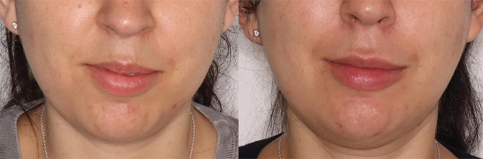 Armonización del tercio facial inferior con ácido hialurónico. - Imagen 1