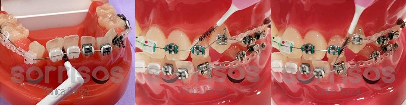 Importancia de la higiene bucal en Ortodoncia - Imagen 2