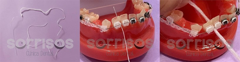 Importancia de la higiene bucal en Ortodoncia - Imagen 1