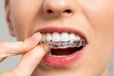 Ventajas del uso de los alineadores dentales. - Imagen 3